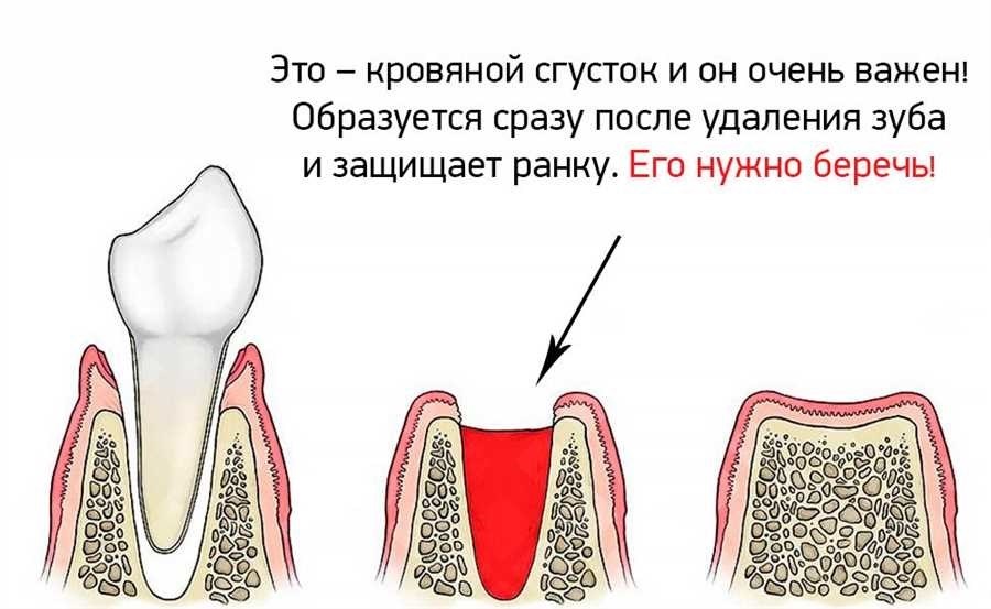 Обязательно ли вставлять зуб после удаления
